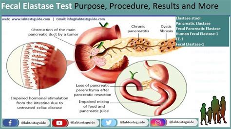 elastaza pancreatica in materii fecale|Diagnostic Performance of Measurement of Fecal Elastase